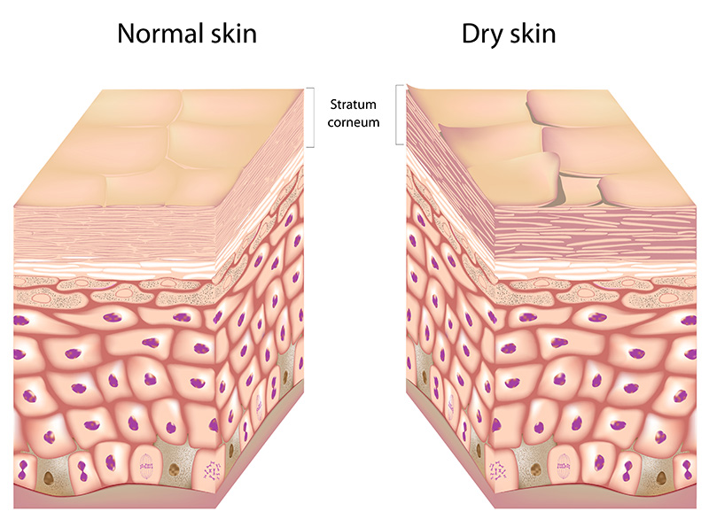 Normal vs. Dry Skin